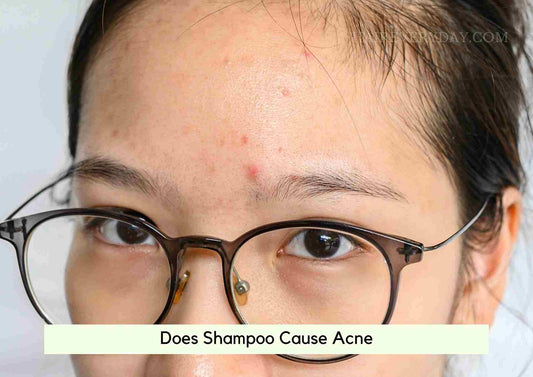 Does Shampoo Cause Acne